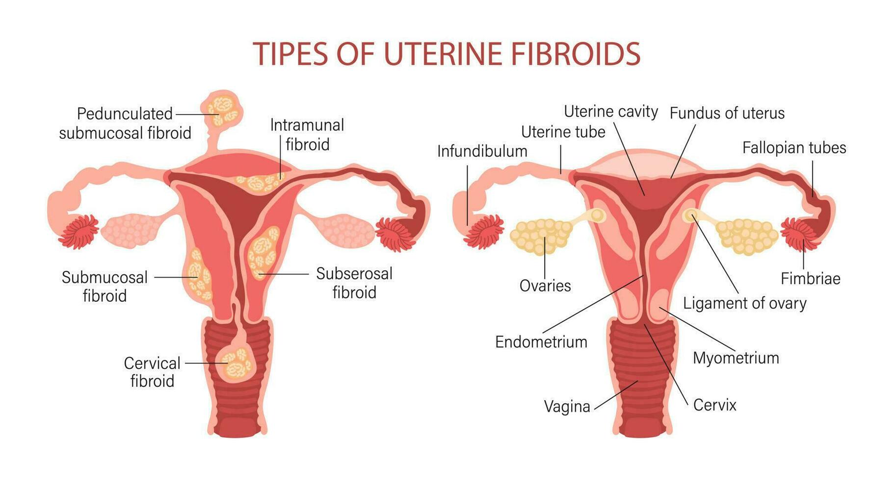 typer av uterin fibroids i kvinnor. myom. sjukdomar av de kvinna reproduktiv systemet. friska och ohälsosam livmoder. gynekologi. medicinsk begrepp. infographic baner. vektor