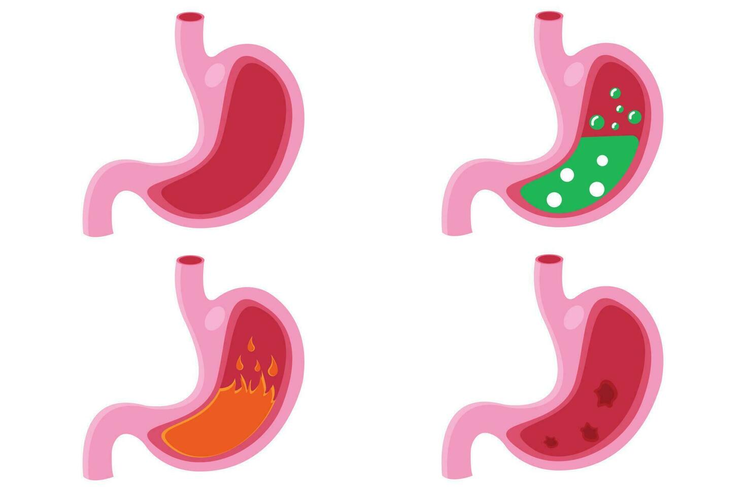 Bauch Symbol Satz, Karikatur Vektor Illustration. normal und abnormal Bauch