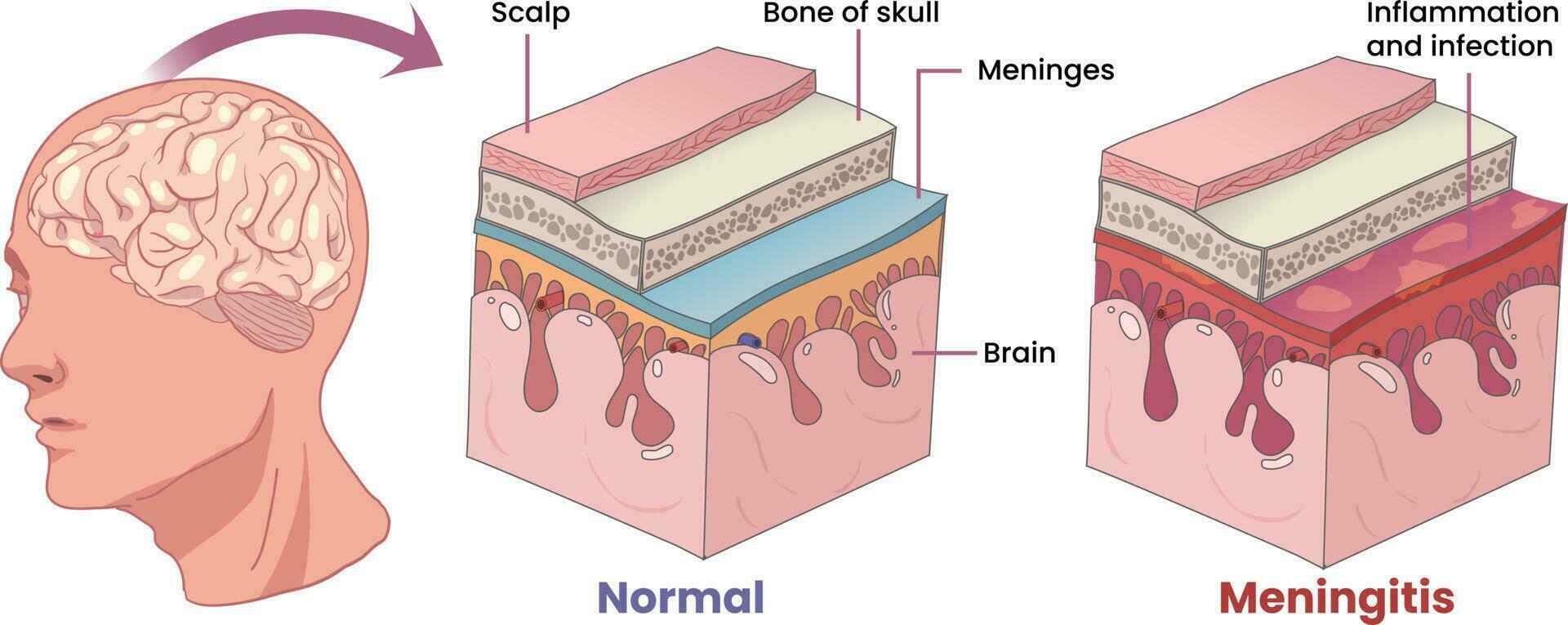 illustration av hjärnhinneinflammation, inflammation membran beläggning de hjärna vektor