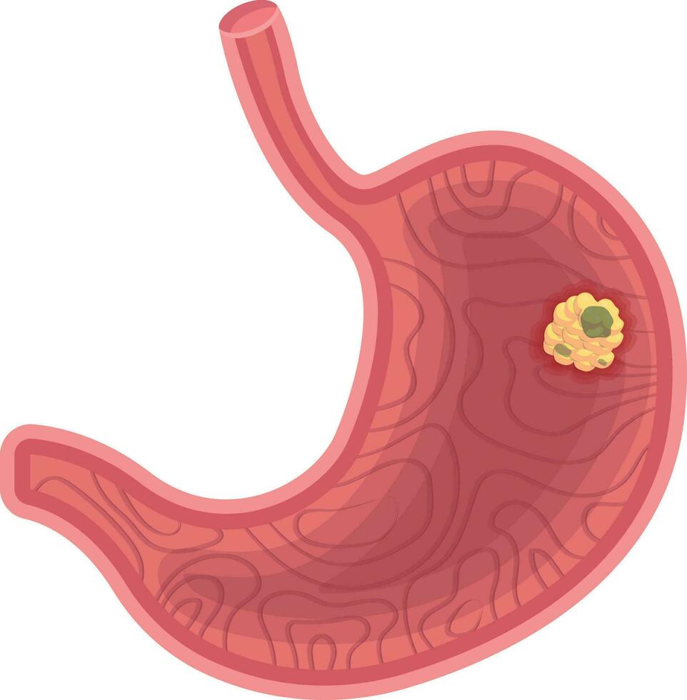 mage cancer vektor illustration isolerat på vit bakgrund