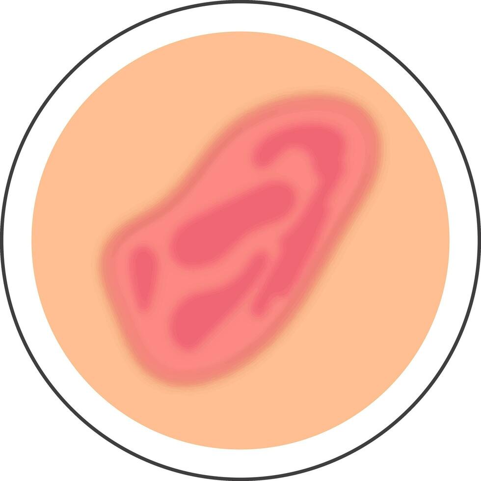 Rosa und Pfirsich Prellung Haut Krankheit Kreis Symbol im eben Stil. vektor