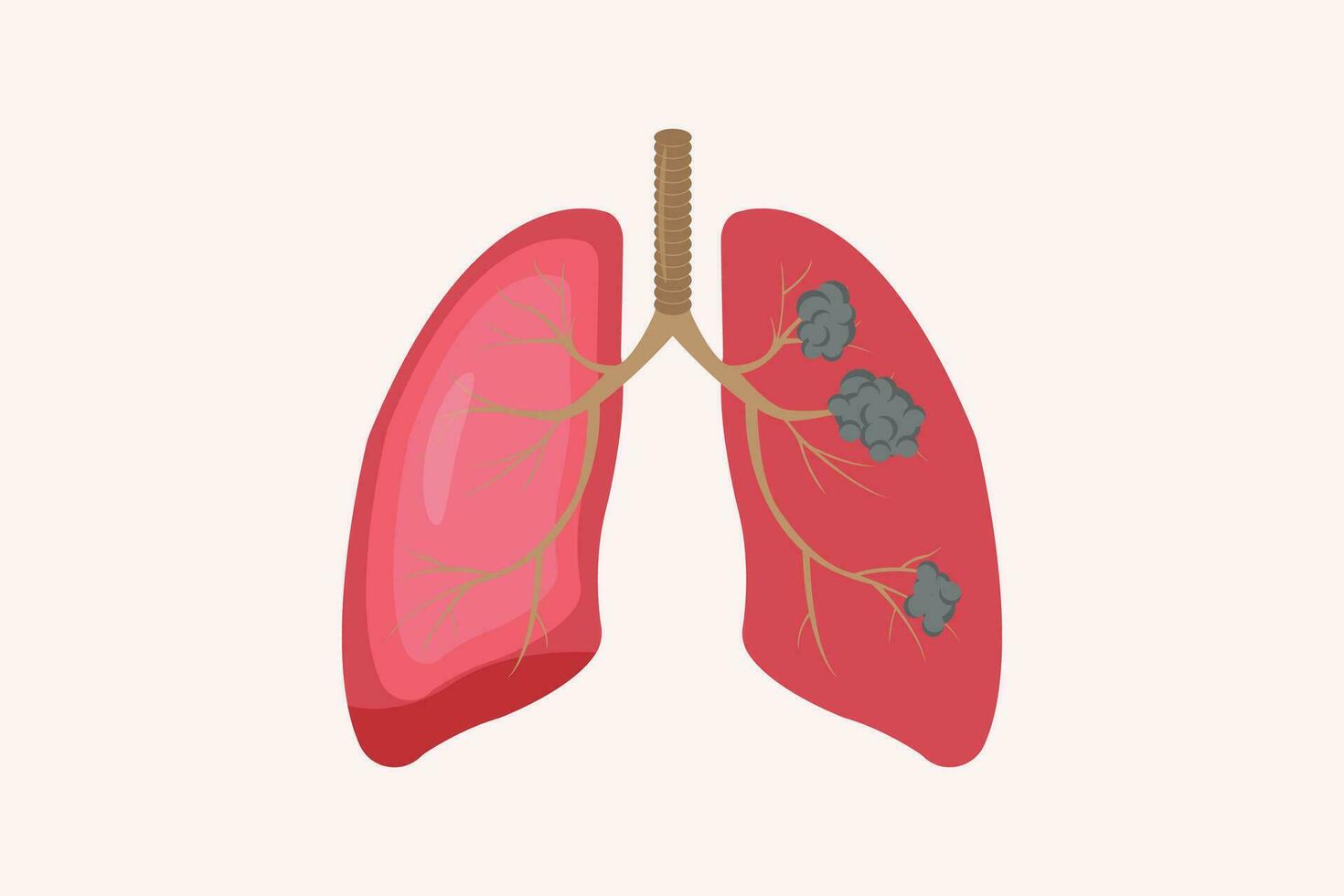 Lunge Krebs und normal Lunge Illustration Vergleich. eps 10. Symbol einstellen vektor