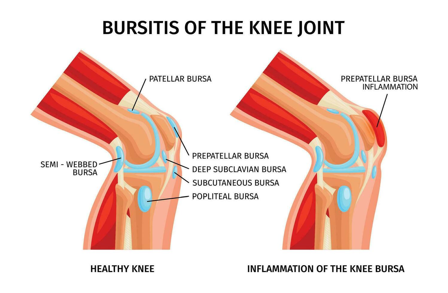 Knie Joint Schleimbeutelentzündung Infografiken vektor
