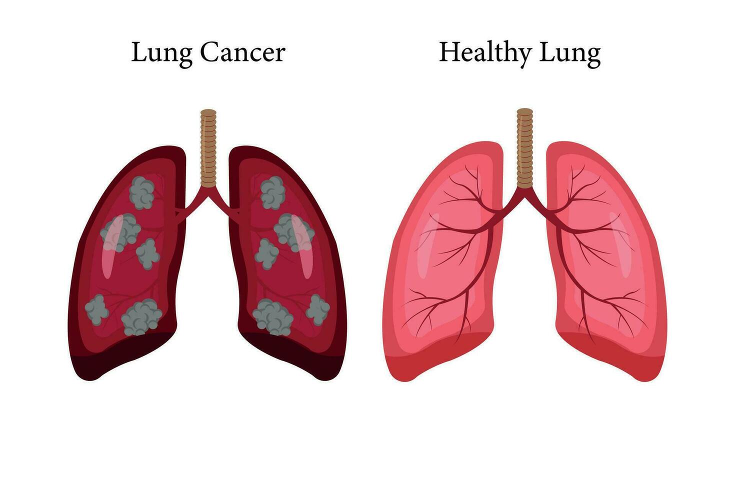 lunga cancer och vanligt lunga illustration jämförelse. eps 10. ikon uppsättning vektor