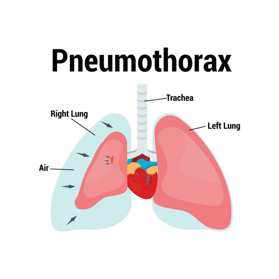 symptom av pneumotorax lunga vektor