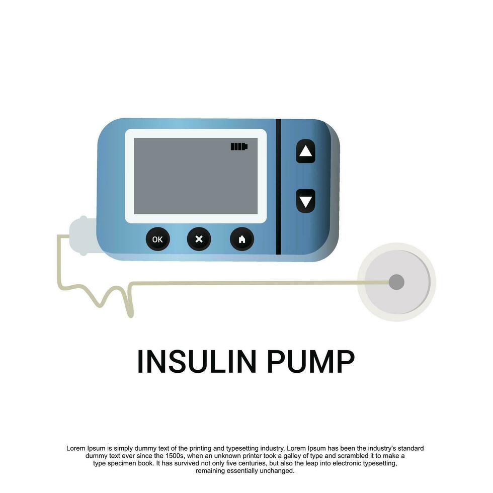 Insulin Pumpe zum Diabetes - - Illustration vektor