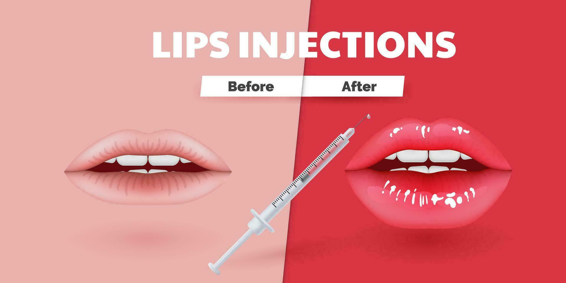 Vor und nach 3d Vektor Illustration präsentieren realistisch Lippe Augmentation. Konzept Highlights das Transformation und Schönheit erreicht durch kosmetisch Verfahren. perfekt zum Werbung Kliniken