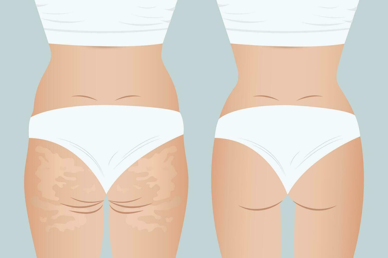 Rückseite Aussicht von ein Mädchen, Illustration Vor und nach Gewicht Verlust. weiblich Zahl mit und ohne Cellulite. Fett Einlagen auf Damen Schenkel. Problem Bereiche von das weiblich Gesäß. vektor