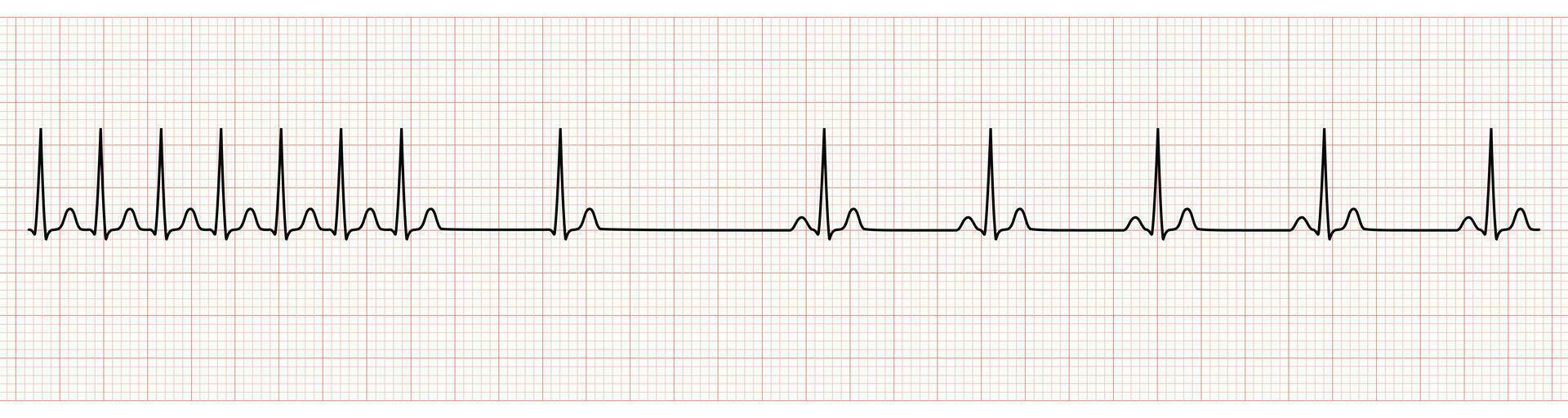 ekg Monitor zeigen supraventrikulär Tachykardie Veränderung zu Sinus Rhythmus nach Adenosin Injektion vektor