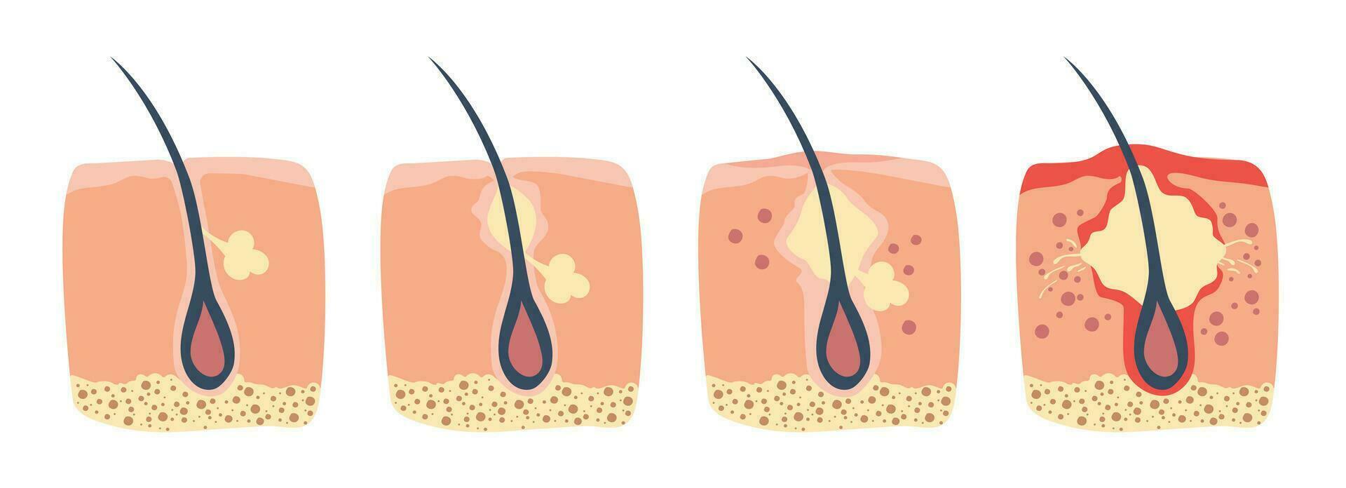 stadier av de hår follikel inflammation i de mänsklig hud. de talg i de igensatt por främjar de tillväxt av en bakterie. detta leder till de rodnad och inflammation, den där associerad med finnar. vektor