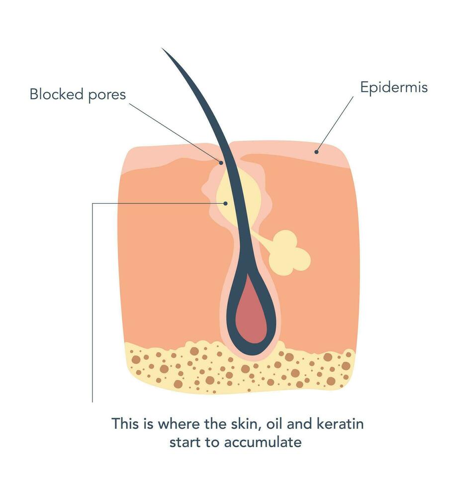 entzündet Haut um das Haar Follikel tief im das Poren. zuerst Bühne von Entzündung, wo Haut, Öl und Keratin erhalten angesammelt. Vektor Illustration