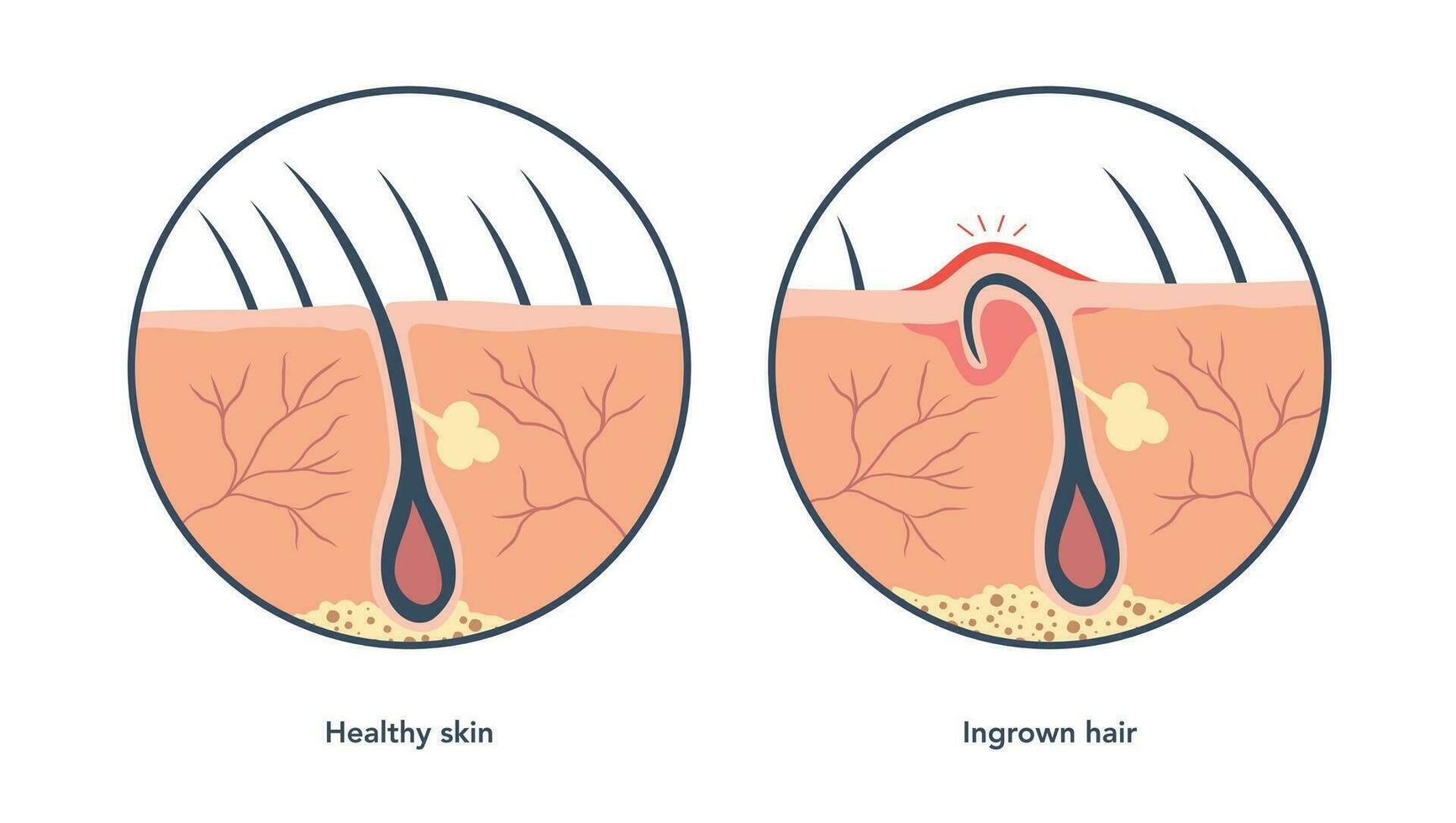 eingewachsen Haar und normal Haar medizinisch Schemata unter Mikroskop. eingewachsen Haar führt zu das Rötung und Entzündung, Das damit verbundenen ebenfalls mit Pickel. Vektor Illustration