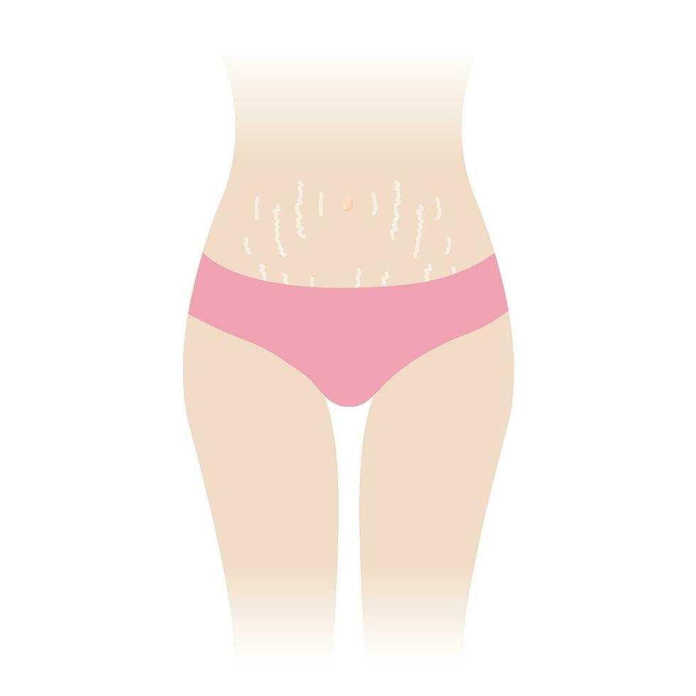 sträcka märken på mage vektor illustration isolerat på vit bakgrund. de vit sträcka märken dyka upp på de buk, mitten mage, mage av kvinna kropp. hud vård och skönhet begrepp.