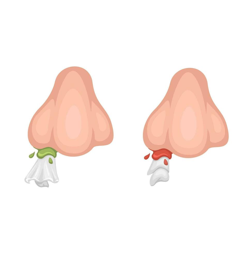 flüssig Nase und Nasenbluten mit Gewebe Symbol Karikatur Illustration Vektor