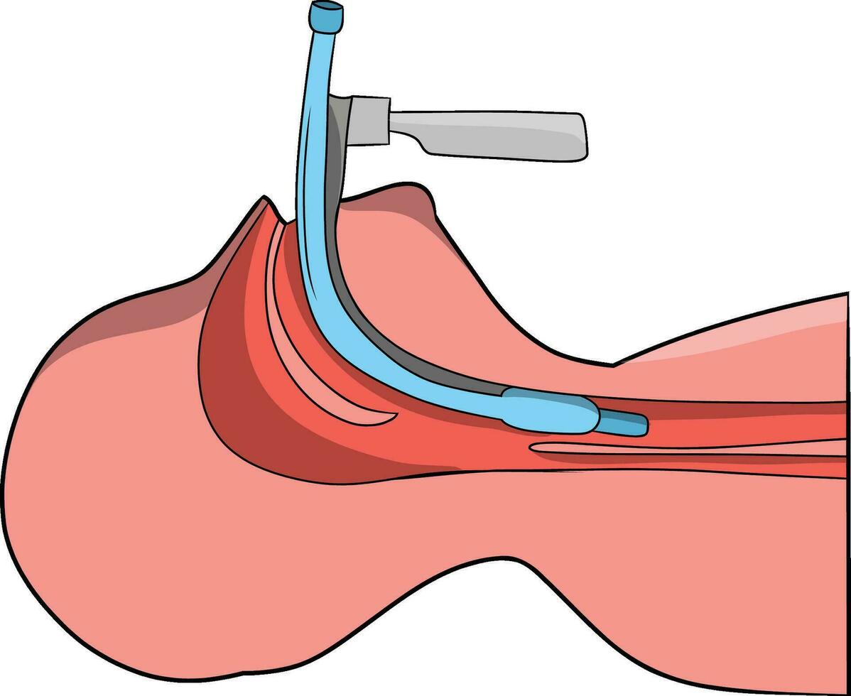 en hand dragen illustration av en medicinsk endotrakeal intubation vektor