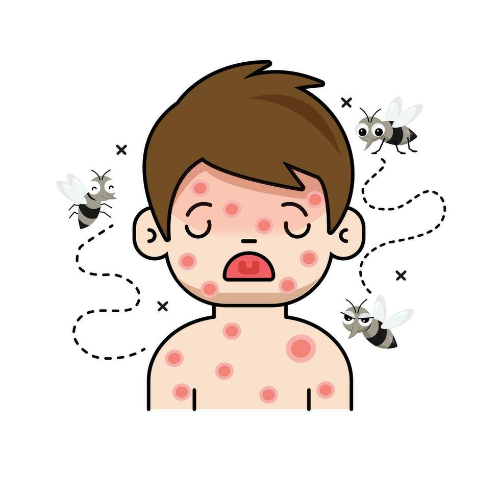 das Kind hat rot Hautausschläge auf seine Körper. fällig zu Sein gebissen durch ein Moskito zu Dengue-Fieber Fieber. vektor