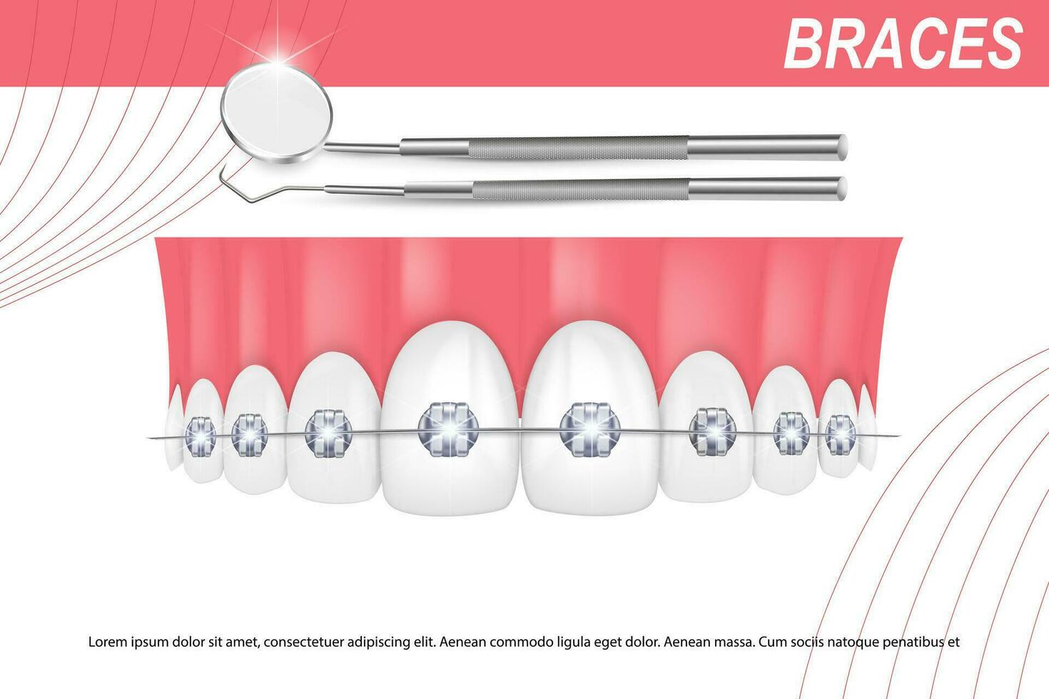 3d Vektor Illustration, realistisch Zähne mit Hosenträger Oberer, höher und niedriger Kiefer. Ausrichtung von das beißen von Zähne, Dentition mit Zahnspange, Dental Hosenträger