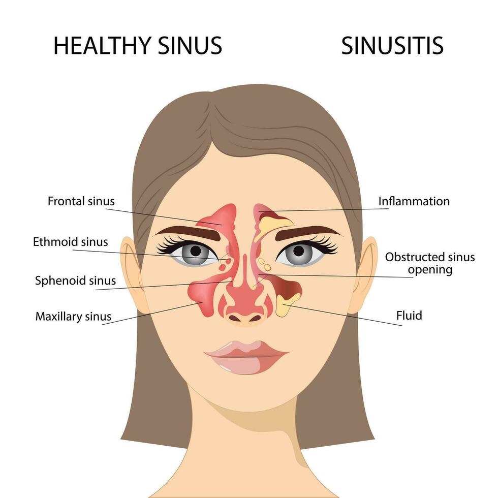 bihåleinflammation, kvinna ansikte med inflammation av de slem- membran av de paranasal och frontal bihålor. vektor illustration för medicinsk posters och pedagogisk material