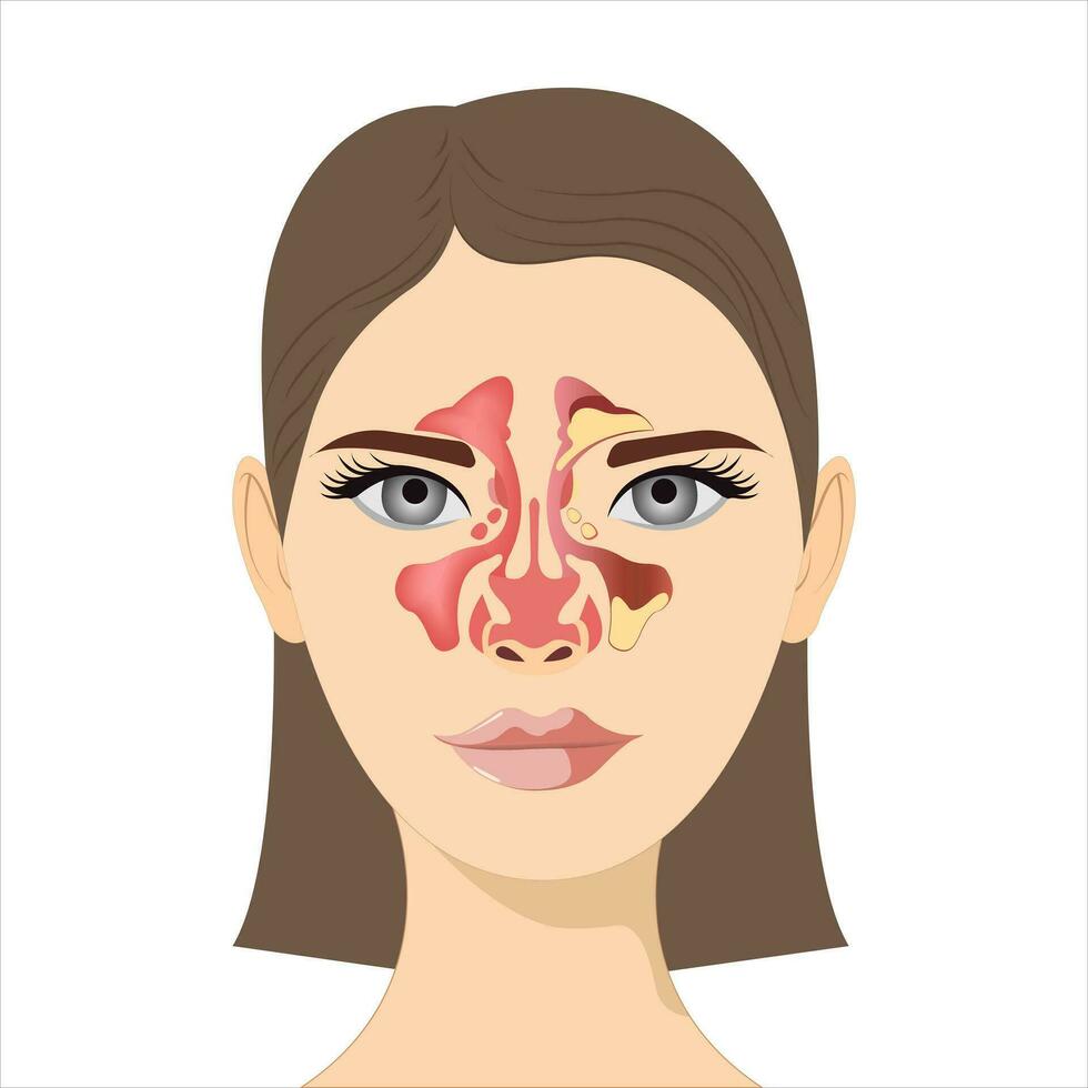 Sinusitis, weiblich Gesicht mit Entzündung von das schleimig Membran von das Nasennebenhöhlen und frontal Nebenhöhlen. Vektor Illustration zum medizinisch Plakate und lehrreich Materialien