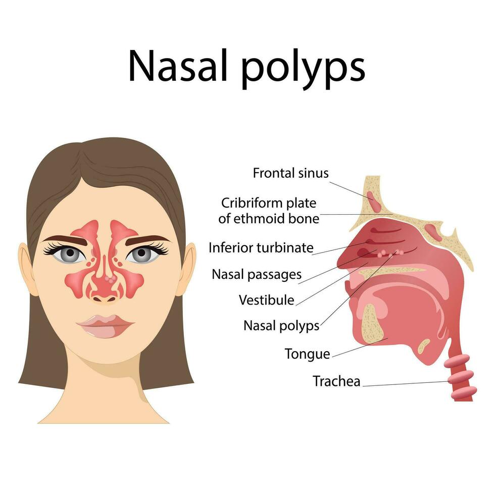 medizinisch Vektor Illustration von Nasal- Polypen. nicht krebserregend Neoplasien auf das Nasal- Schleimhaut oder Nebenhöhlen auf ein Weiß Hintergrund
