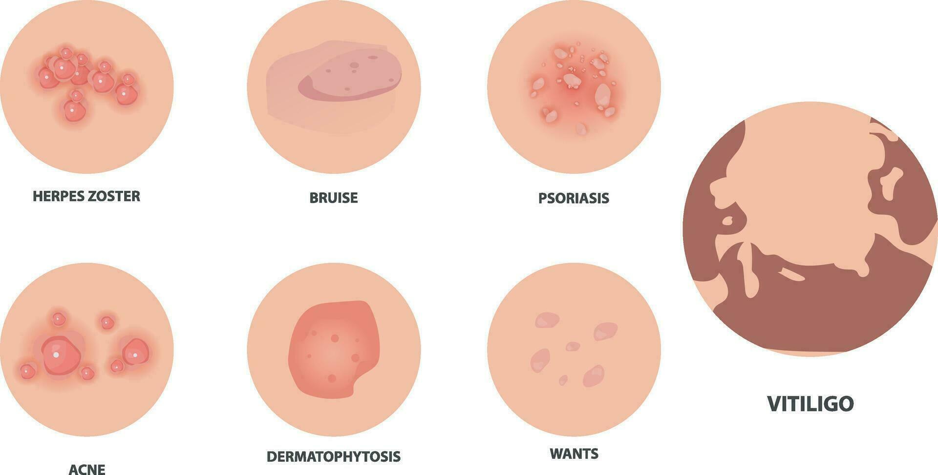 annorlunda typer av psoriasis vektor uppsättning. del av patienter hud med dermatit, inflammation, röd utslag och Övrig hud problem vektor illustration lämplig för kvinnors hud hälsa problem