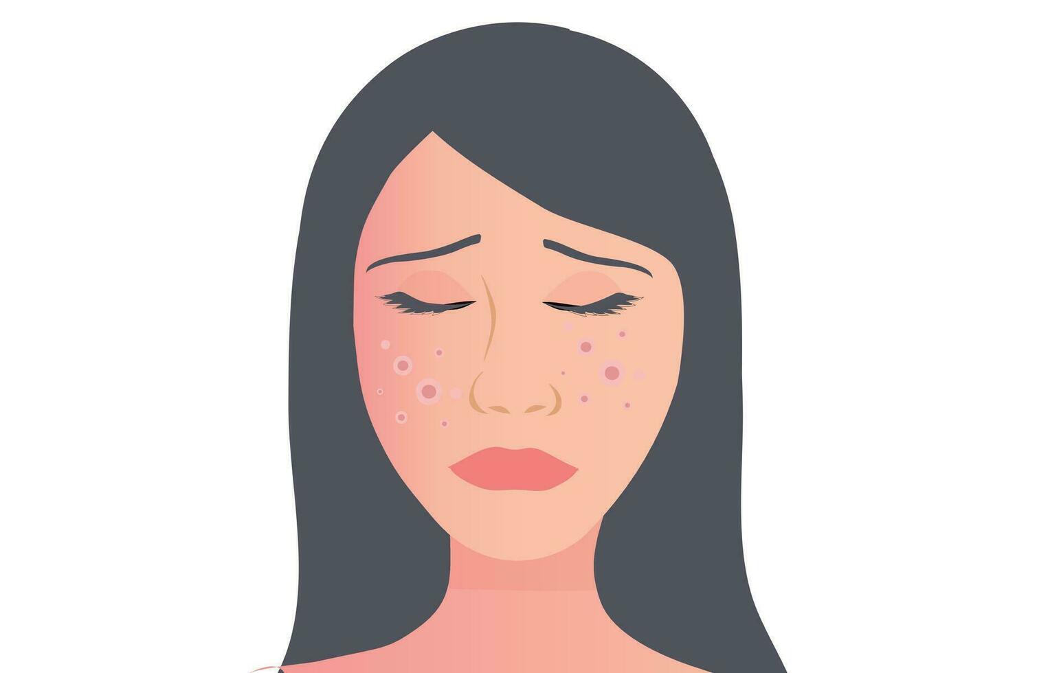 ung kvinna ansikte med hud acne, finnar, pormaskar vektor illustration. acne hud ansikte problem