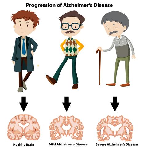 En framsteg av Alzheimers sjukdom vektor