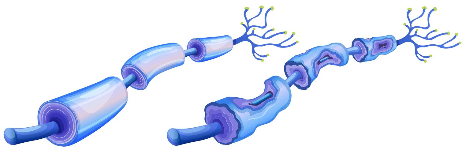 Humane Nervenzelle und periphere Neuropathie vektor