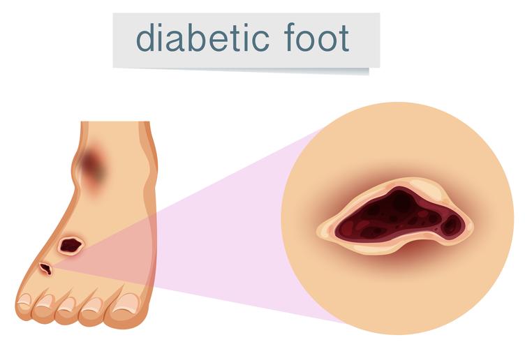 Ein menschlicher Fuß mit Diabetiker vektor