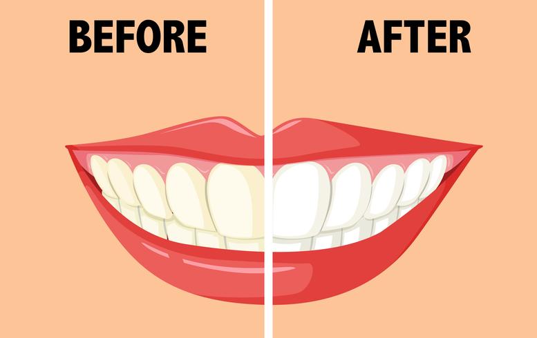 Före och efter borstning av tänder vektor