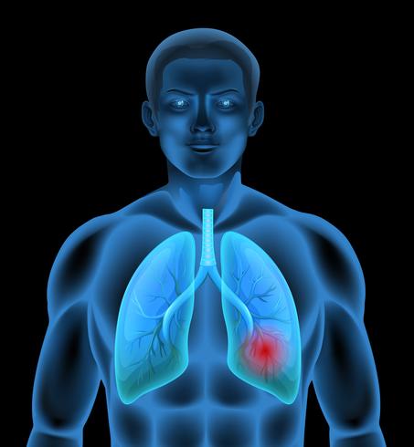 Eine menschliche Anatomie der Lungenkrankheit vektor