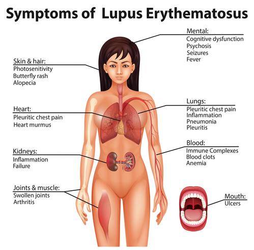 Menschliche Anatomie Symptome von Lupus Erythematodes vektor