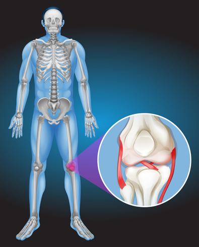 Människokropp och smärta i knäet vektor