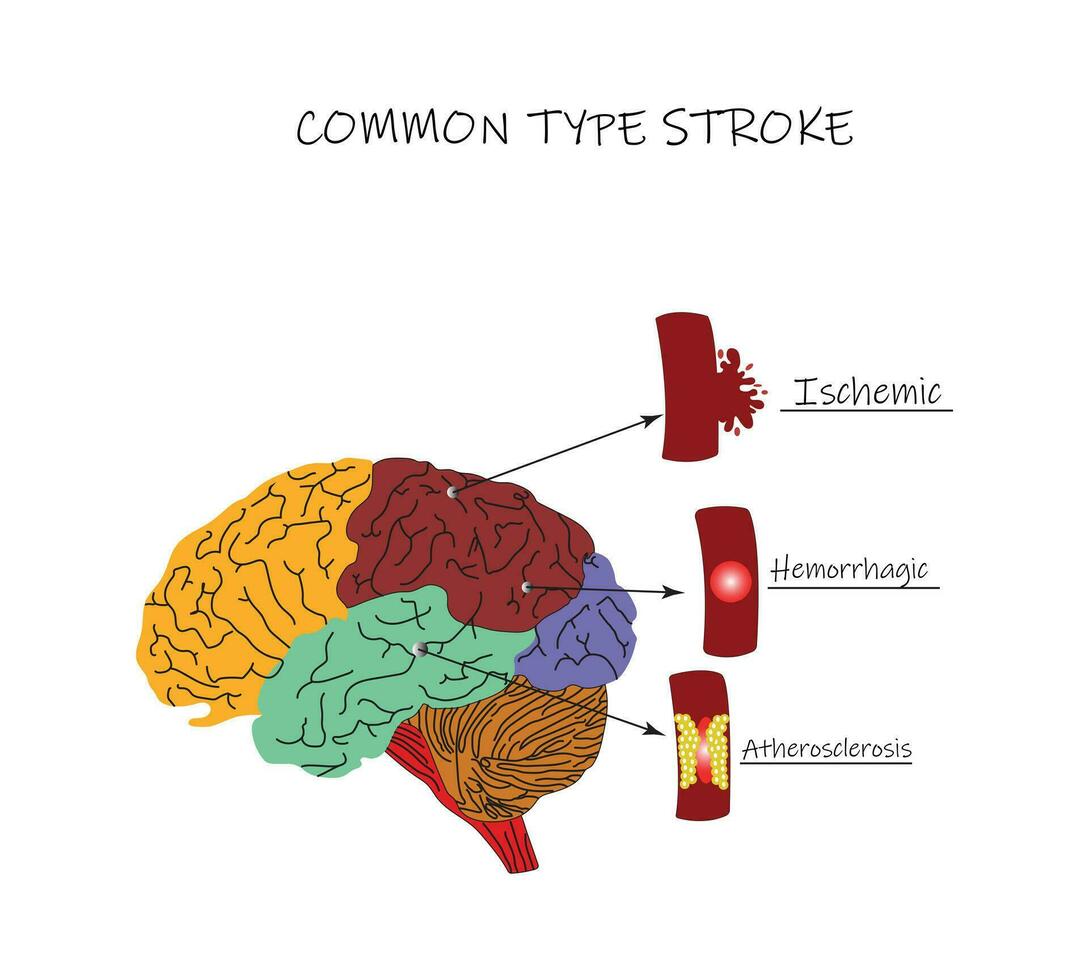 ett allmänning typ av hjärna stroke är karaktäriseras förbi hjärna vävnad rör på sig under de mitten vika ihop av de dura falx. detta typ är kallad en subalpin hjärna herniation vektor