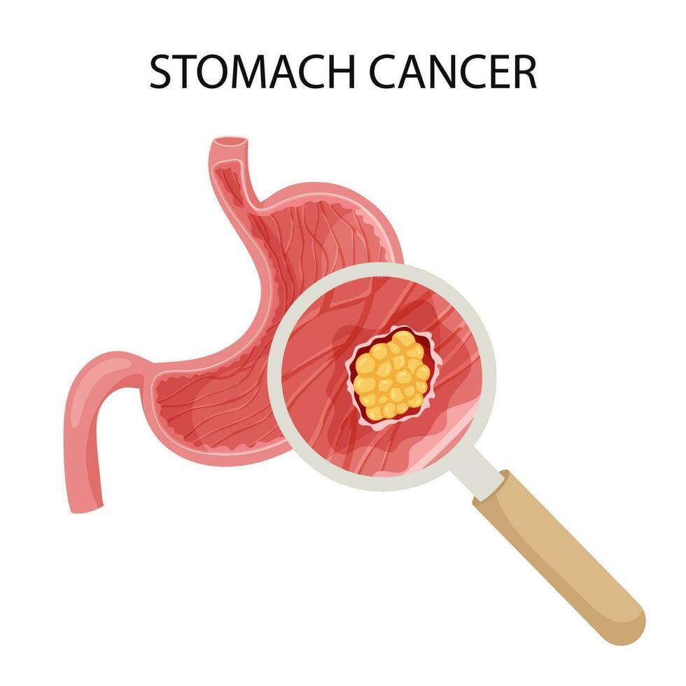 Bauch Krebs. maligne krebsartig Tumor vergrößert unter Vergrößerung Glas. anatomisch Vektor Illustration isoliert Weiß Hintergrund Karikatur Stil