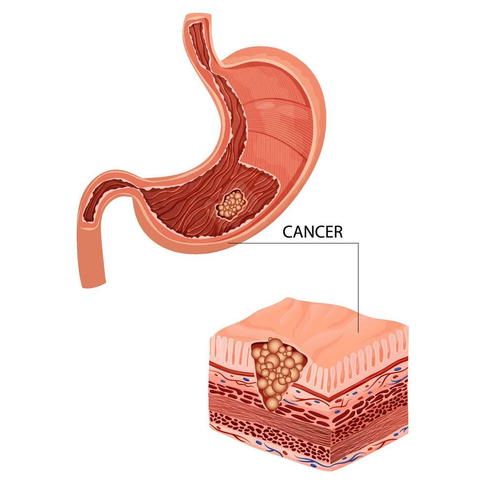 Bauch Krebs. maligne krebsartig Tumor. anatomisch Vektor Illustration isoliert Weiß Hintergrund Karikatur Stil