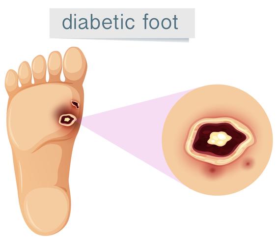 Ein diabetischer Fuß auf weißem Hintergrund vektor