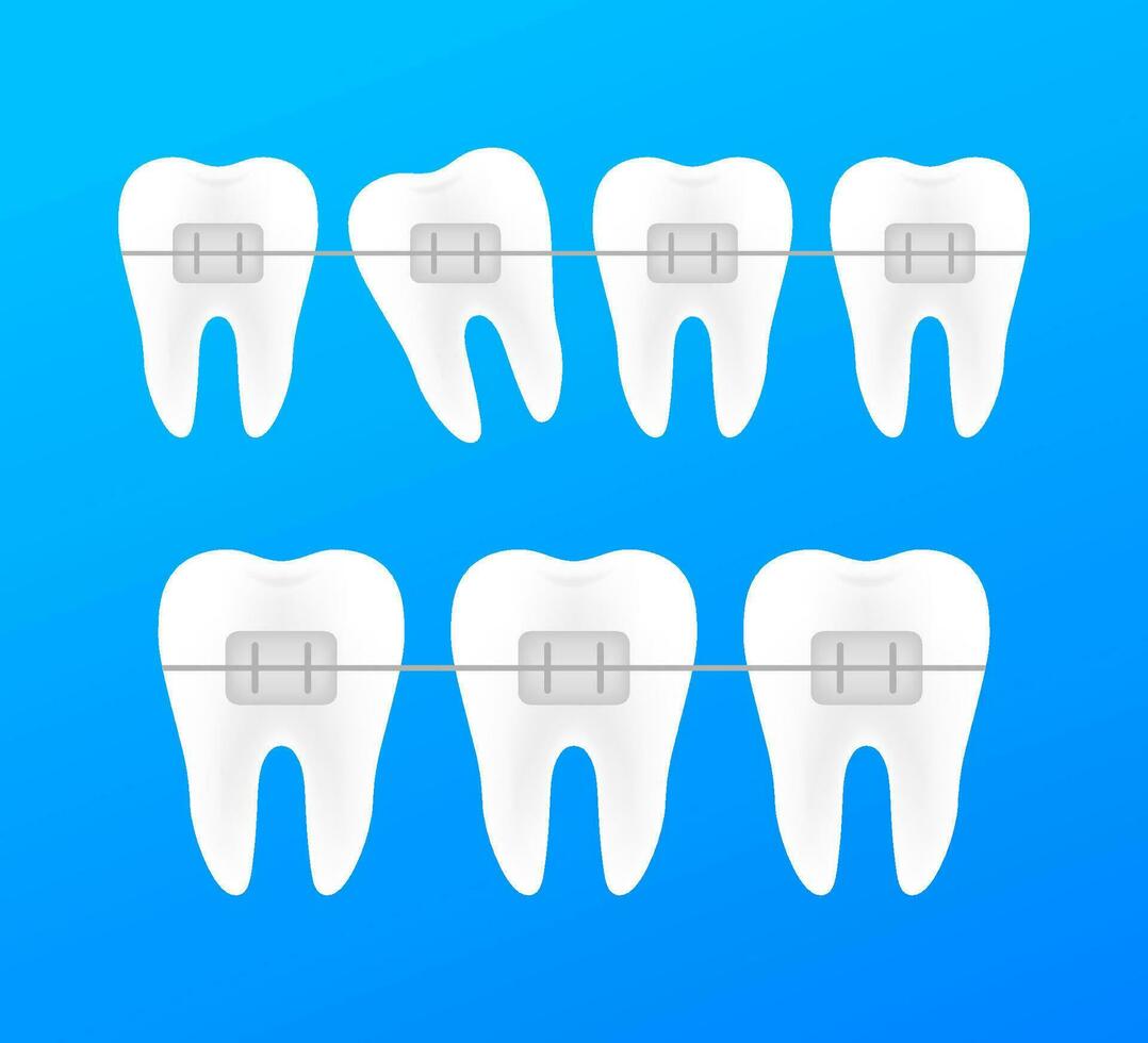 Korrektur von Zähne mit kieferorthopädisch Zahnspange. Stufen von Zähne Ausrichtung. Dental Klinik Dienstleistungen. Vektor Illustration