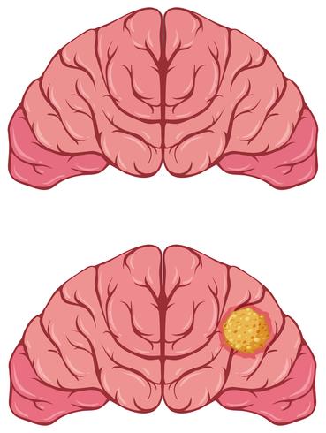 Menschliches Gehirn mit Krebs vektor