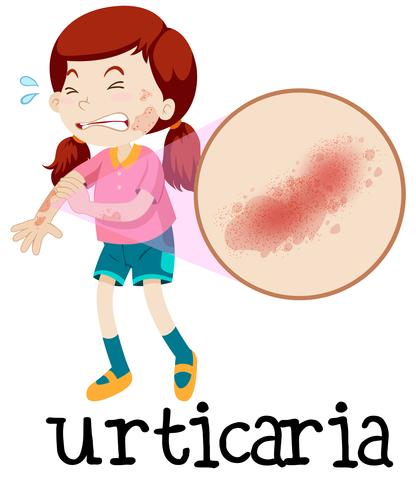Ein Mädchen mit Urticaria auf weißem Hintergrund vektor