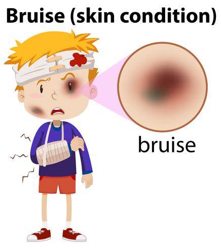En pojke som har bruise på ansikte vektor