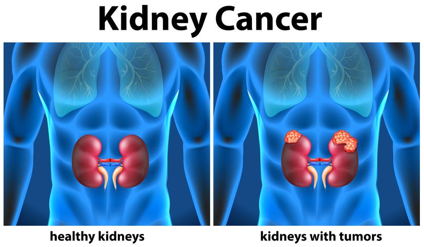 Diagram som visar njurcancer hos människa vektor