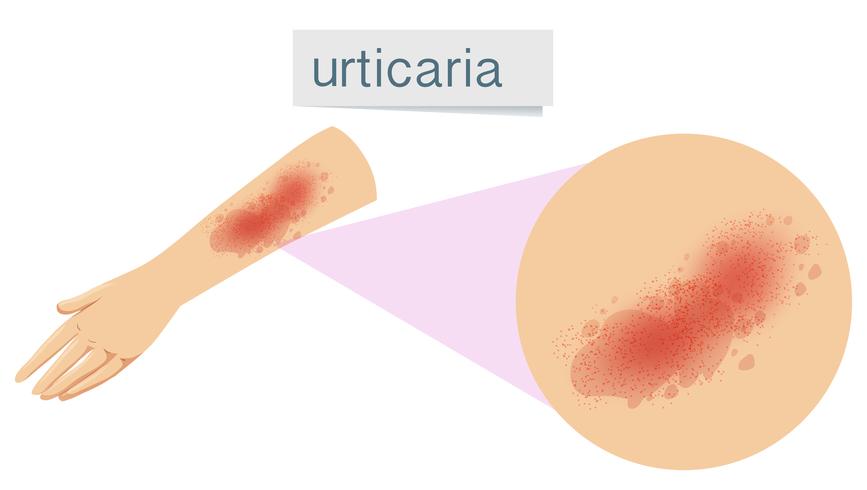 Ett mänskligt hudproblem Urticaria vektor