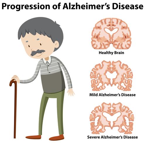 Progression av Alzheimers sjukdom vektor