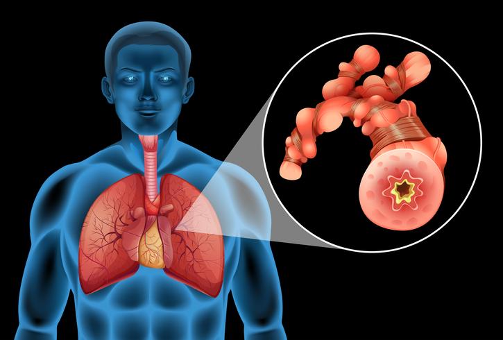 Menschen mit Tumor in der Lunge vektor