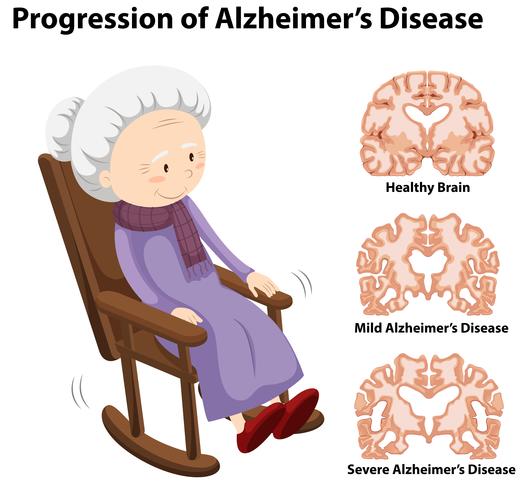 Fortschreiten der Alzheimer-Krankheit vektor