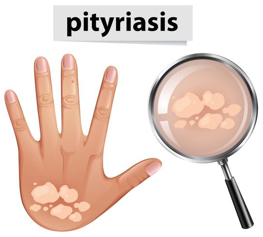 Ein Vektor von Pityriasis auf der menschlichen Haut