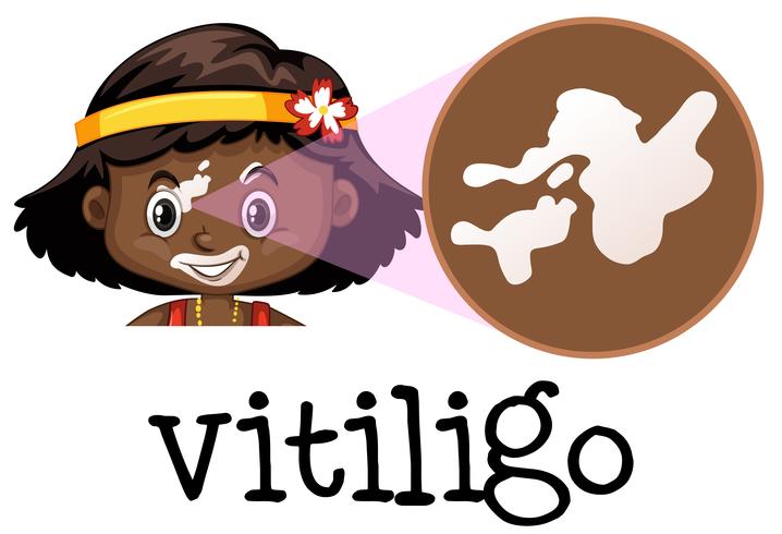 Humanmedizinische Ausbildung von Vitiligo vektor