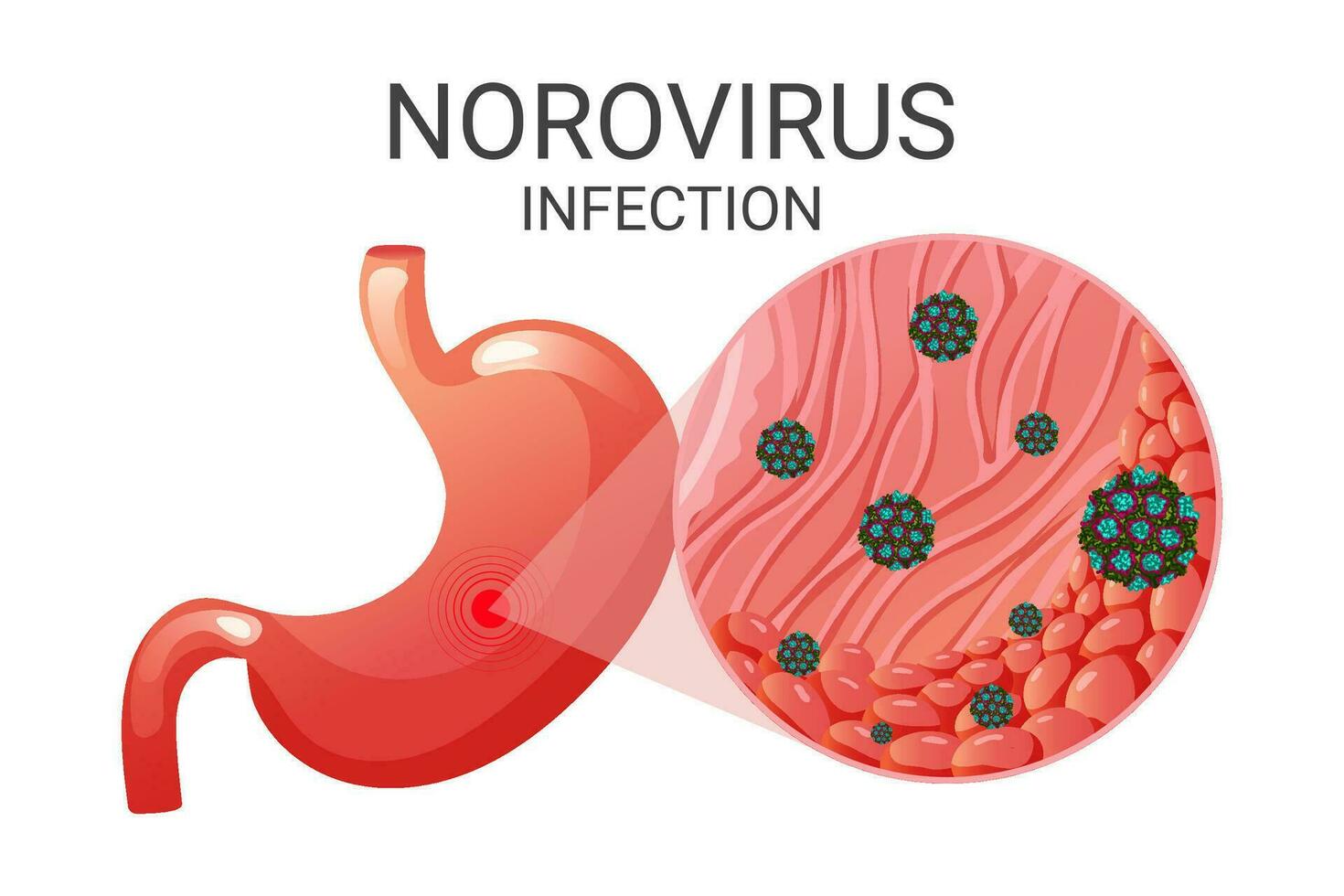 Norovirus im Bauch epithelial Zellen unter Vergrößerung vektor