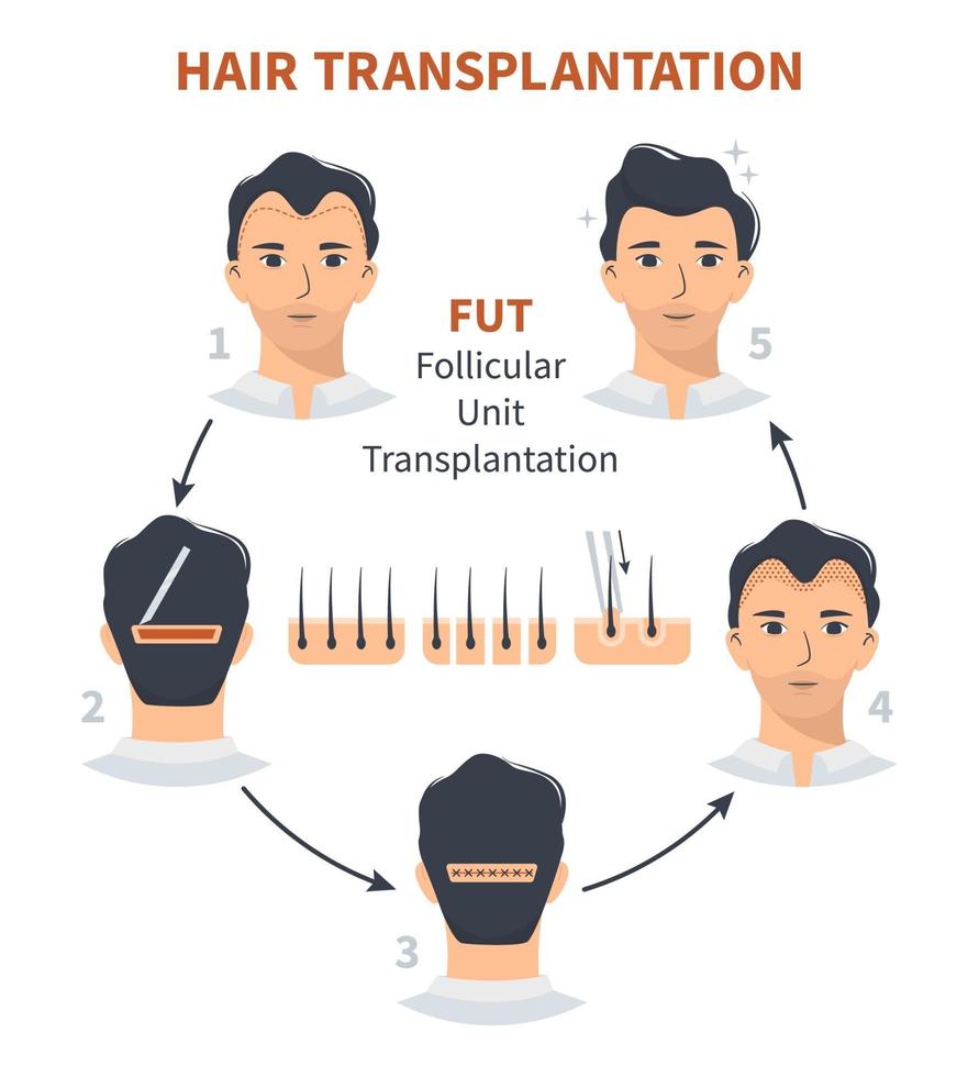 Stadien der Haartransplantation für die Follikeleinheit vektor